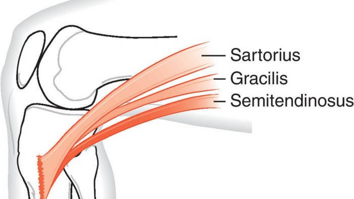 Inserción de los músculos que forman la pata de ganso.