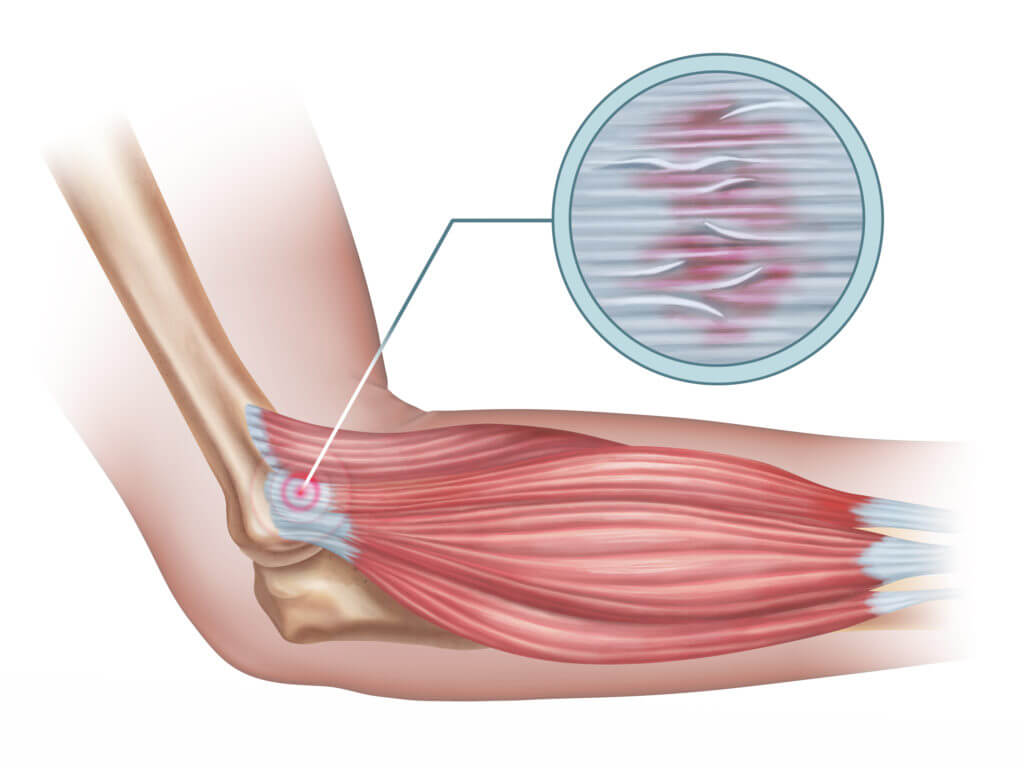 Tendinitis Vs Tendinosis