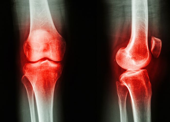 Cómo tratar la artrosis de rodilla en fisioterapia? - Clínica Arias