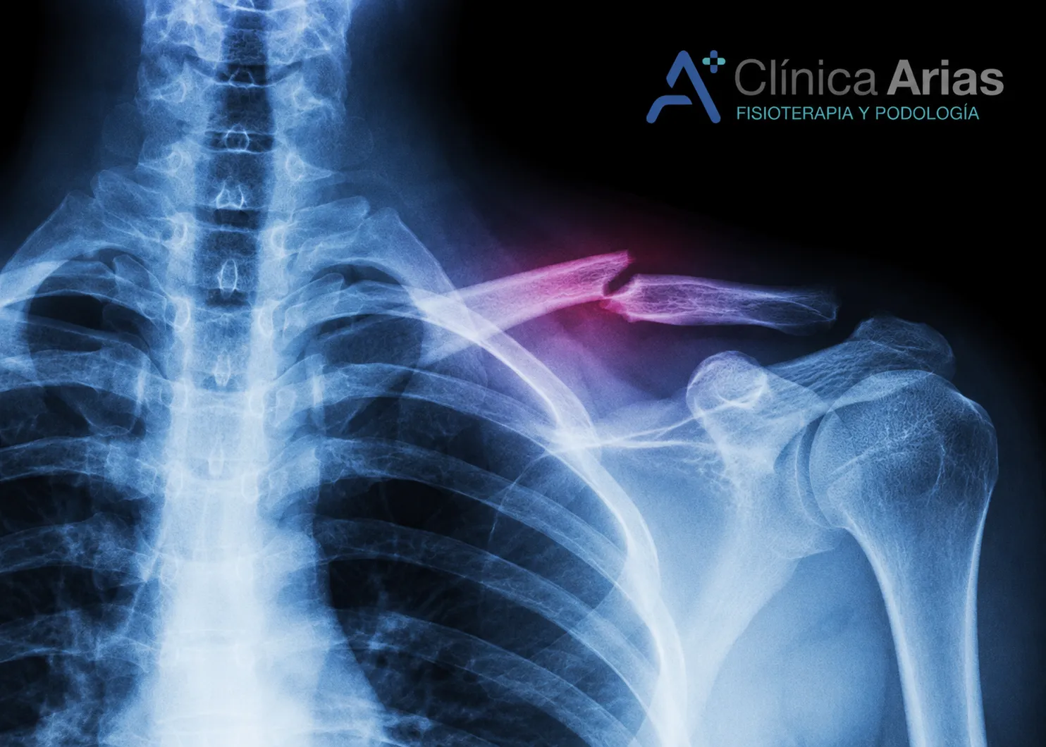 Técnicas de fisioterapia para tratar la fractura de clavícula 1 Fractura-de-clavicula-en-Clinia-Arias